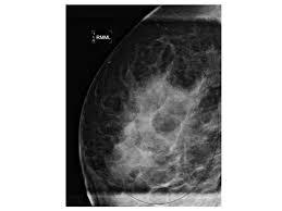 Negative and close margins:when margins are ink. Stage 0 Breast Cancer Dcis Lcis Cancer Therapy Advisor