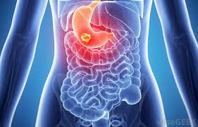 As the stage advances, the symptoms of benign stomach tumors may become more severe. What Is Abdominal Cancer With Pictures