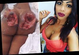 But what happens when the plastic surgery procedure goes wrong? Woman 26 Left With Gaping Wounds After Brazilian Butt Lift Goes Horribly Wrong The Sun Happy Lifestyle Inc