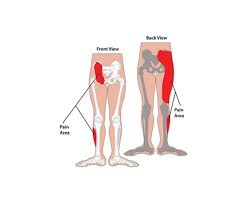 Treatment goals include providing joint pain relief. Sacroiliac Joint Pain Treatment Kingston Surrey Uk Physio More