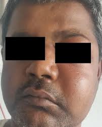 Rhizopus are the most common species, with. Sars Cov 2 Uncontrolled Diabetes And Corticosteroids An Unholy Trinity In Invasive Fungal Infections Of The Maxillofacial Region A Retrospective Multi Centric Analysis Springerlink