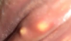 There are two main types of hood piercing, the vertical clitoral hood piercing and the horizontal clitoral hood piercing. Two Bumps On Clit Pimples Sexual Health Forums Patient