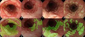 Differential diagnosis between herpes simplex virus (hsv) esophagitis and cytomegalovirus (cmv) esophagitis is challenging because there are many similarities and overlaps between their. Machine Learning Approach For Differentiating Cytomegalovirus Esophagitis From Herpes Simplex Virus Esophagitis Scientific Reports
