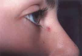 Both men and women can be prone to cherry angiomas, and it all comes down to genetics. Cherry Angioma Dover Oh Canton Oh Ohio Laser Wellness Centers