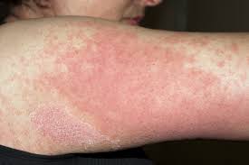 We did not find results for: Quick Facts Drug Rashes Msd Manual Consumer Version