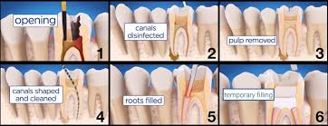 On average, 16.4 million teeth in the united states receive root canal treatment every year. Los Angeles Center For Endodontics The Experts In Endodontic Care