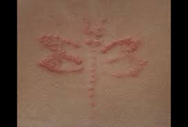 Here's what you'll learn in this post: Allergic Contact Dermatitis Picture Image On Medicinenet Com