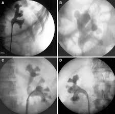 (icf), with a classification system and theoretical model based on the combination of the medical and social models and using a biopsychosocial approach to integrate the health dimensions. Influence Of The Renal Lower Pole Anatomy And Mid Renal Zone Classification In Successful Approach To The Calices During Flexible Ureteroscopy Springerlink