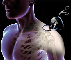 Shoulder surgeon