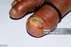 Image result for Paronychia feet