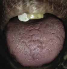 Image result for Fissured tongue