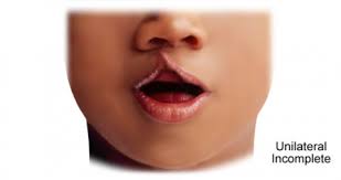 Image result for Cleft Lip
