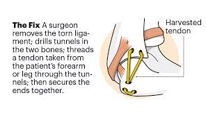 Sang ho baek, 20, had been battling injuries throughout the season, a teammate said, and underwent tommy john surgery, a relatively common procedure for pitchers. Why Tommy John Is Against The Surgery Named For Him