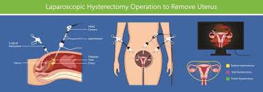 No More Pain And Tiny Scars How A Laparoscopic Hysterectomy Gives Women Their Lives Back South China Morning Post