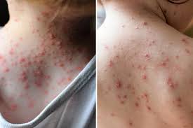 Image result for chickenpox