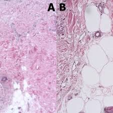 The use of topical lotions or drugs is not preferred due to the difficulty of application twice a day, to the odor of the treatment, to the irritation and the allergies, to the residue on the hair after application, and to. Pdf Dermal Adipose Tissue In Hair Follicle Cycling Possible Applications In Alopecia