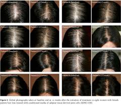 Kerastem stem cell therapy is a one of its kind treatment that helps to reverse the earlier stages of hair loss to restore hair growth and arrest the process of balding/thinning. New Study Use Of Aape Adipose Derived Stem Cell Conditioned Media Adsc Cm In Female Pattern Hair Loss Bauman Medical