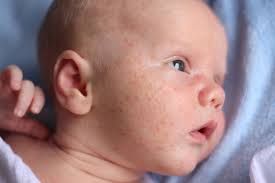 Mums usually give their baby an oil massage before the bath. Natural Solutions For Newborn With Red Dry Cheeks Lovetoknow