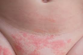 Windeldermatitis Behandlung Und Vorbeugung