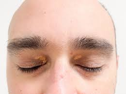 Image result for xantelasma