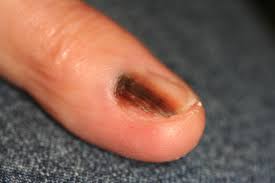 Some types of skin cancer are more dangerous than others, but if you have a spot. Subungual Melanoma Doccheck