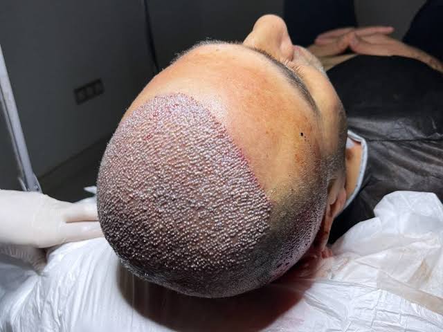 Hair Transplantation Techniques - O Clinic Hair Transplant - Hair Transplant  & Aesthetic