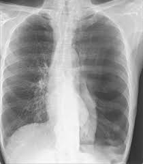 Air can enter the pleural space by two mechanisms, either. Artificial Intelligence That Reads Chest X Rays Is Approved By Fda Uc San Francisco