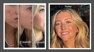 Two year difference with deep pore set