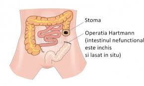 Por lo general, comienza como grupos pequeños y no cancerosos (benignos) de células llamados pólipos que se. Cancerul De Colon