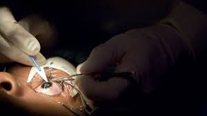 How Much Does Laser Eye Surgery Cost In India