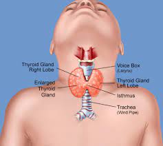 Can Thyroid Cause Swollen Lymph Nodes In Neck