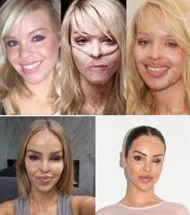 🔥 **17 Years of Unbreakable Courage** After surviving a horrific acid  attack that left one eye blind and her body scarred — and after enduring  **250+ life-saving surgeries** — **Katie Piper** has