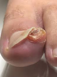Image result for Onychotillomania feet