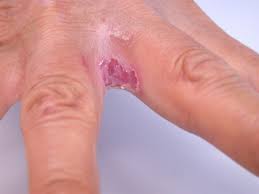 Image result for Skin Infection