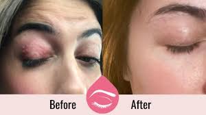 The presenting signs of eyelid skin cancers are highly variable. Eyelid Dermatitis Itchy Irritated Eyelids