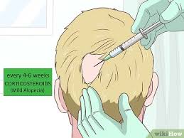 Alopecia areata is not a sign or symptom of a more serious or underlying condition. 3 Ways To Treat Alopecia Wikihow
