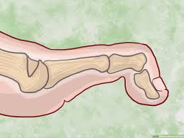 4 Ways To Straighten Toes Wikihow 4 ways to straighten toes wikihow