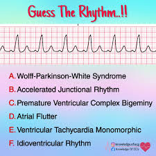Complete av block, junctional escape rhythm, and ventriculophasic sinus arrhythmia 2nd degree av block, type i, with accelerated junctional escapes and a ladder diagram ecg of the century: Facebook