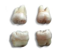 Extraction site looks white after 3 days. Wisdom Tooth Wikipedia
