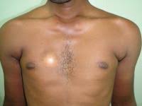 Learn about symptoms of breast cancer in men and things that may increase your risk. à¤ª à¤° à¤· à¤¸ à¤µà¤§ à¤¨ à¤¸ à¤¨ à¤® à¤¯ 6 à¤¬à¤¦à¤² à¤µ à¤¦ à¤à¤¨ à¤²à¤ à¤¤ à¤¸à¤®à¤ à¤² à¤à¤² à¤¦ à¤¹ à¤¨ à¤µ à¤² à¤¹ à¤¬ à¤° à¤¸ à¤ à¤ à¤¸à¤° à¤¤ à¤° à¤¤ à¤à¤° à¤¯ à¤ à¤®