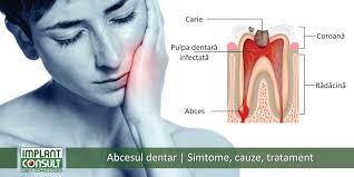 Abcesul dentar se sparge singur? Abcesul Dentar Simptome Cauze Tratament
