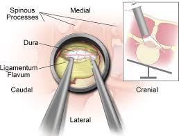 We did not find results for: The Ligamentum Flavum Is Then Carefully Removed Using Kerrison Download Scientific Diagram