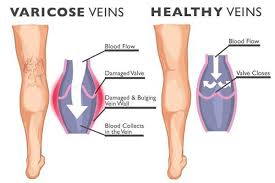 Pembengkakan pada pembuluh darah (vena varikosa) dapat menimbulkan rasa sakit dan mengganggu penampilan. Vena Varikos Di Kaki Semasa Mengandung Apa Yang Perlu Dilakukan Ciri Ciri Rawatan