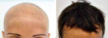 Efficacy And Safety Of Methotrexate In Alopecia Areata