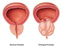 Enlarged Prostate Problem Natural Remedies To Shrink The Prostate In Painless Way Enlarged Prostate Prostate Health Prostate