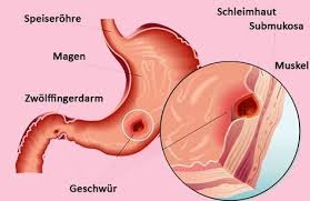 Nur Ein Schluck Von Diesem Getrank Genugt Und Die Leber Wird Erneuert Njuskam Magengeschwur Geschwur Naturliche Behandlungsmethoden