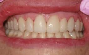 The teeth attached to the partial denture framework are custom fabricated to match your natural teeth as closely as possible. Smile Gallery Village Dental