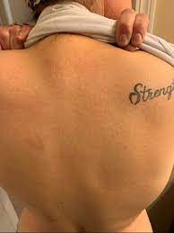 Hydroxychloroquine And Rash I Was Recently Lupus Uk