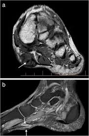 The muscles acting on the foot span from above the knee to various points on the foot skeleton. Mri Imaging Of Soft Tissue Tumours Of The Foot And Ankle Insights Into Imaging Full Text