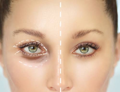 How Much Does an Eyelid Surgery Cost? - OcalaEye Eyelids